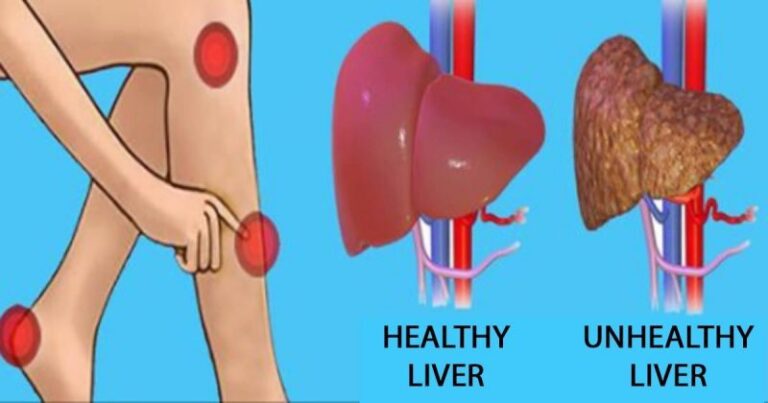 Semnele de avertizare că ficatul este supraîncărcat cu toxine și pe care nu trebuie să le ignori