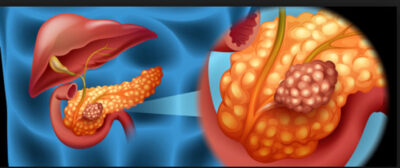 Semnele timpurii ale cancerului pancreatic, una cele mai grave forme de cancer.