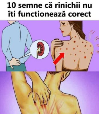 Aceste SEMNE subtile îți arată că rinichii tăi sunt în mare pericol…